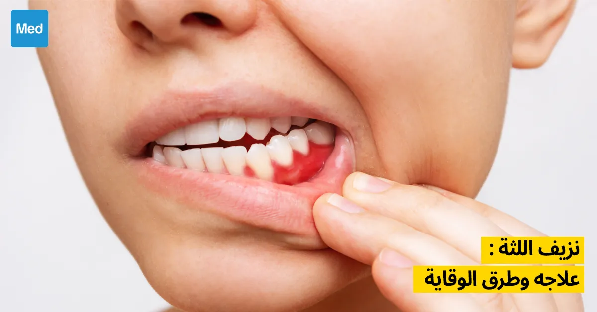 نزيف اللثة: كيفية التعامل معه والوقاية منه